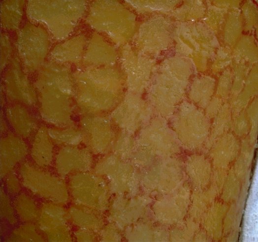 Eczema Craquele